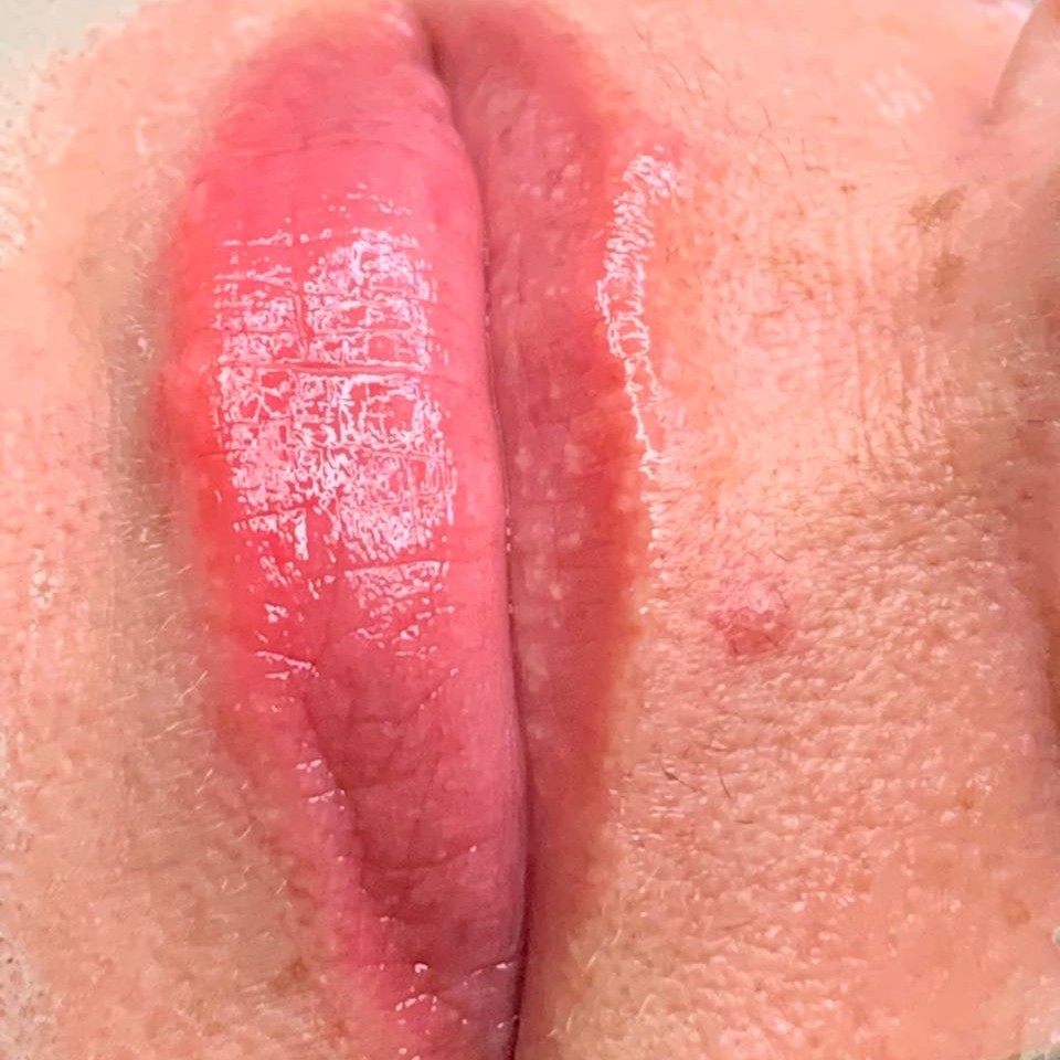 Depois — Hydragloss Labial